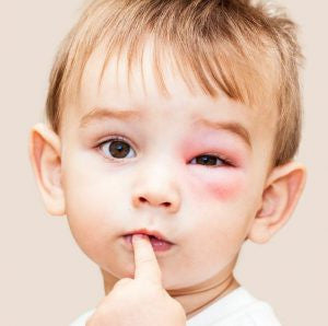 Know the symptoms of a severe allergic reaction.